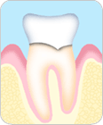軽度歯周病