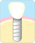 インプラント治療　ステップ４